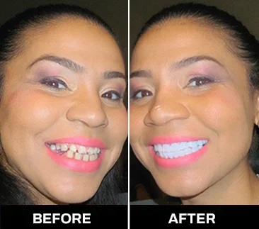 Shiny Smile Veneers